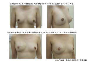 乳房再建（インプラント）